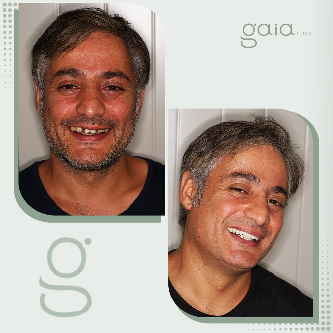 before-after
