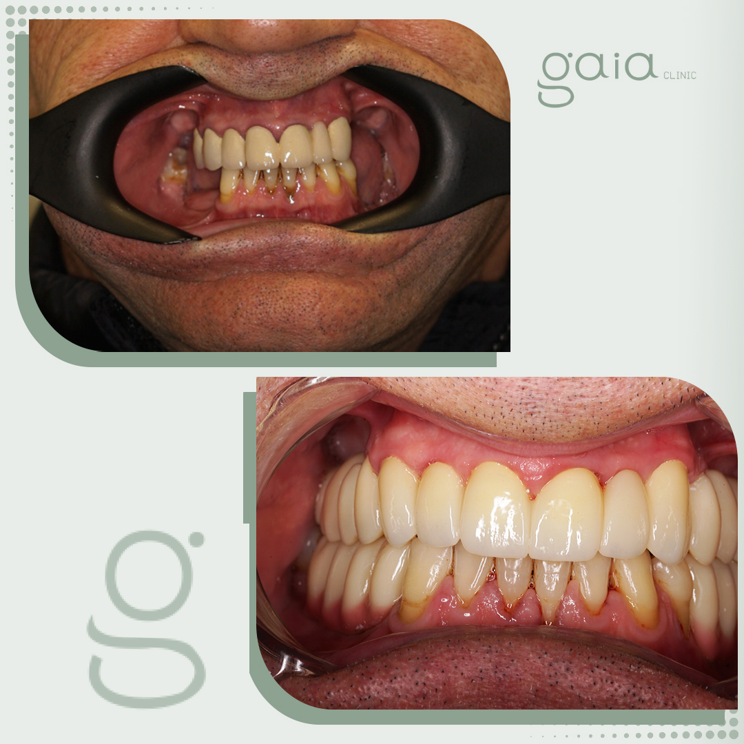 before-after
