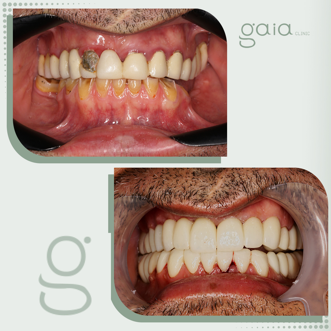 before-after