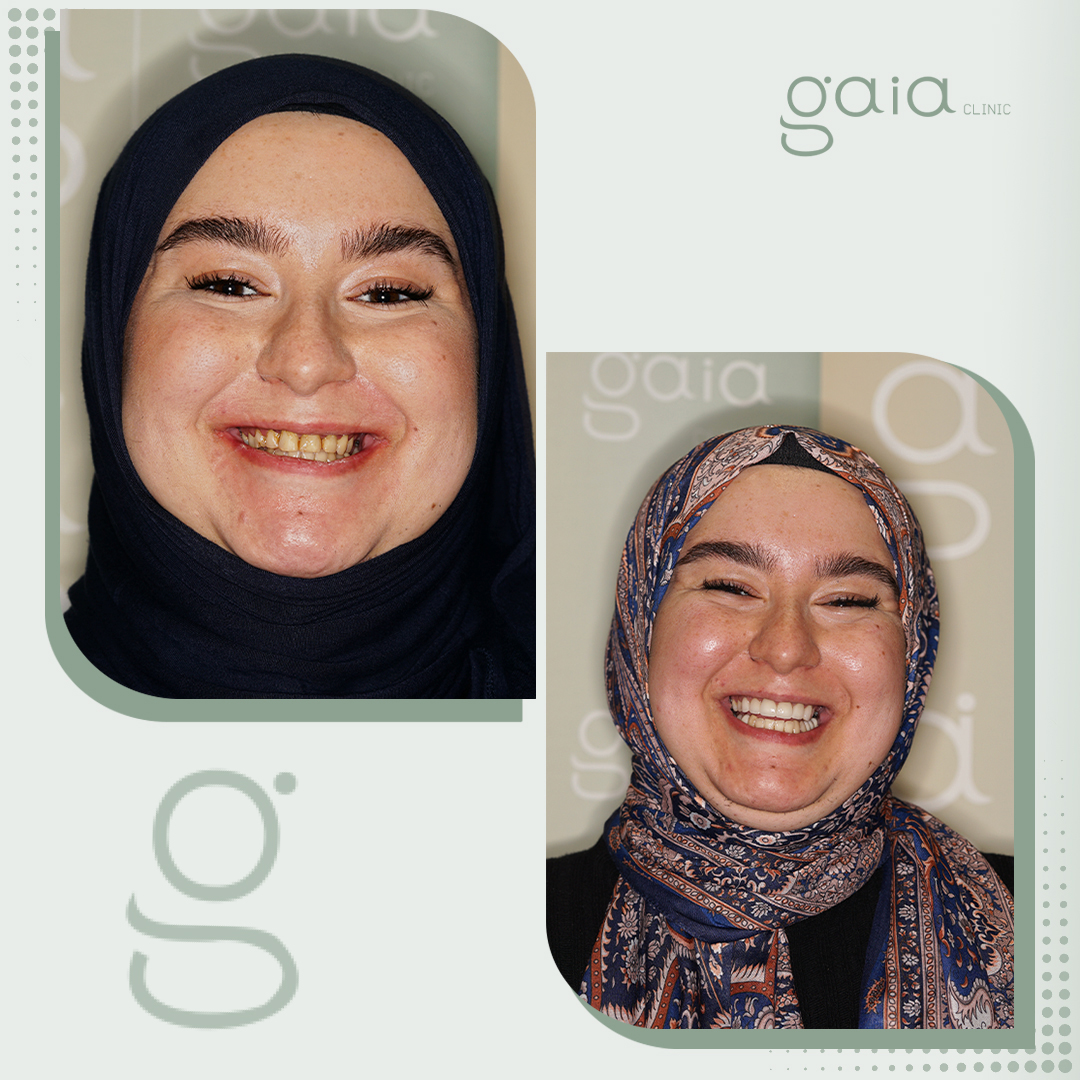 before-after