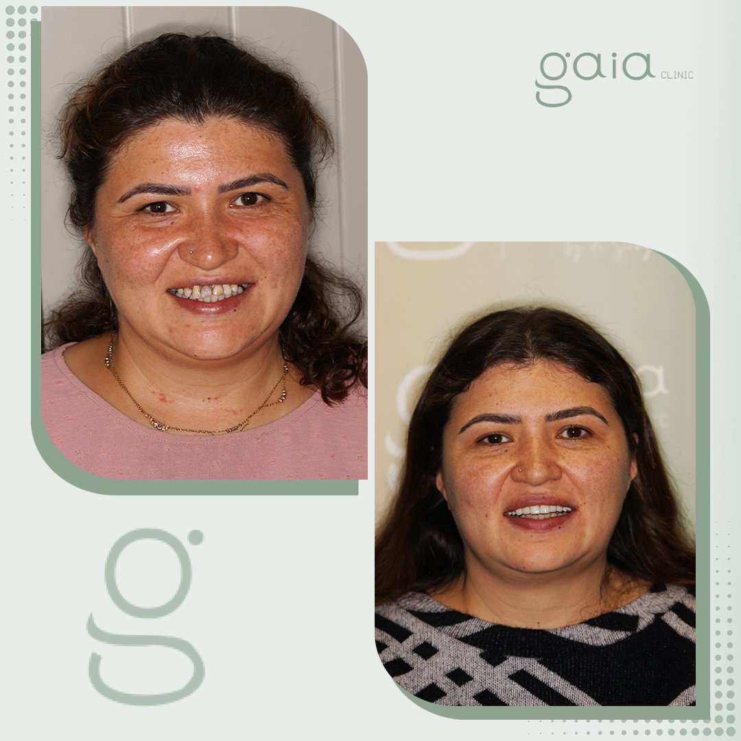 before-after