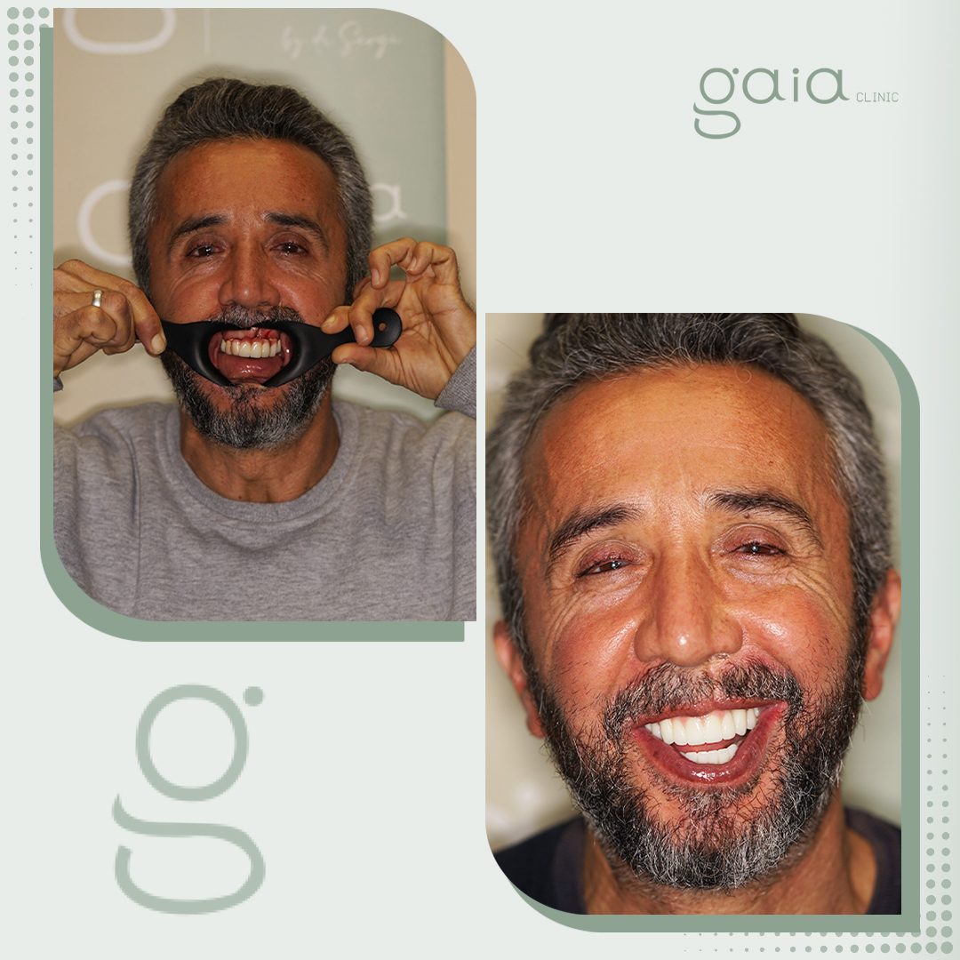 before-after