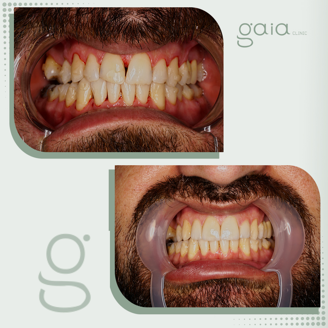 before-after