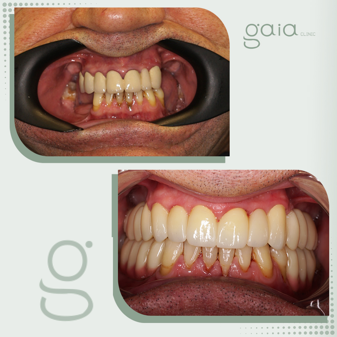 before-after