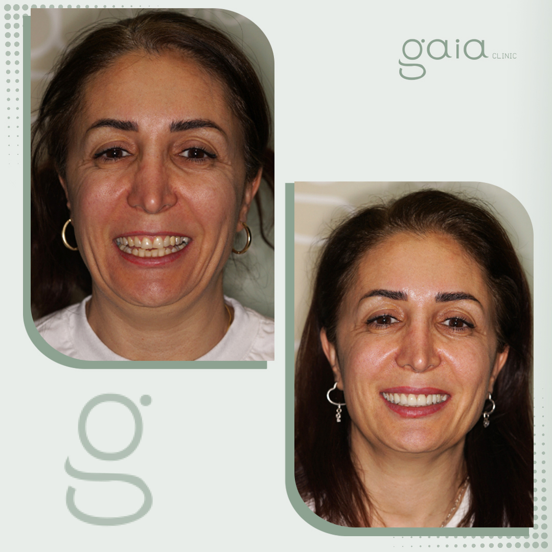 before-after