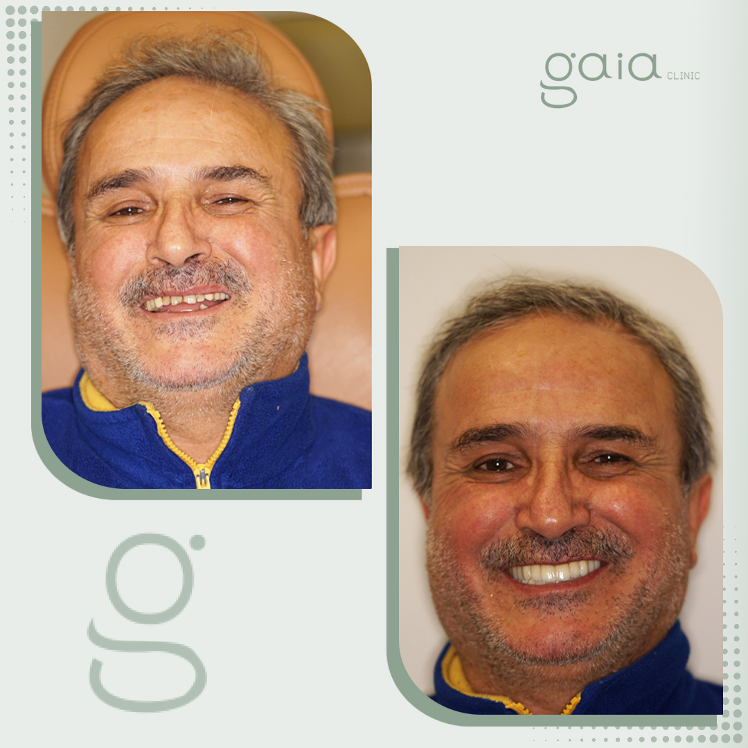 before-after