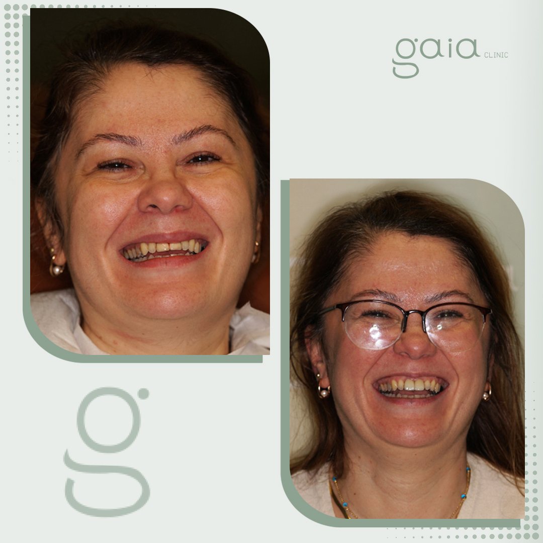 before-after