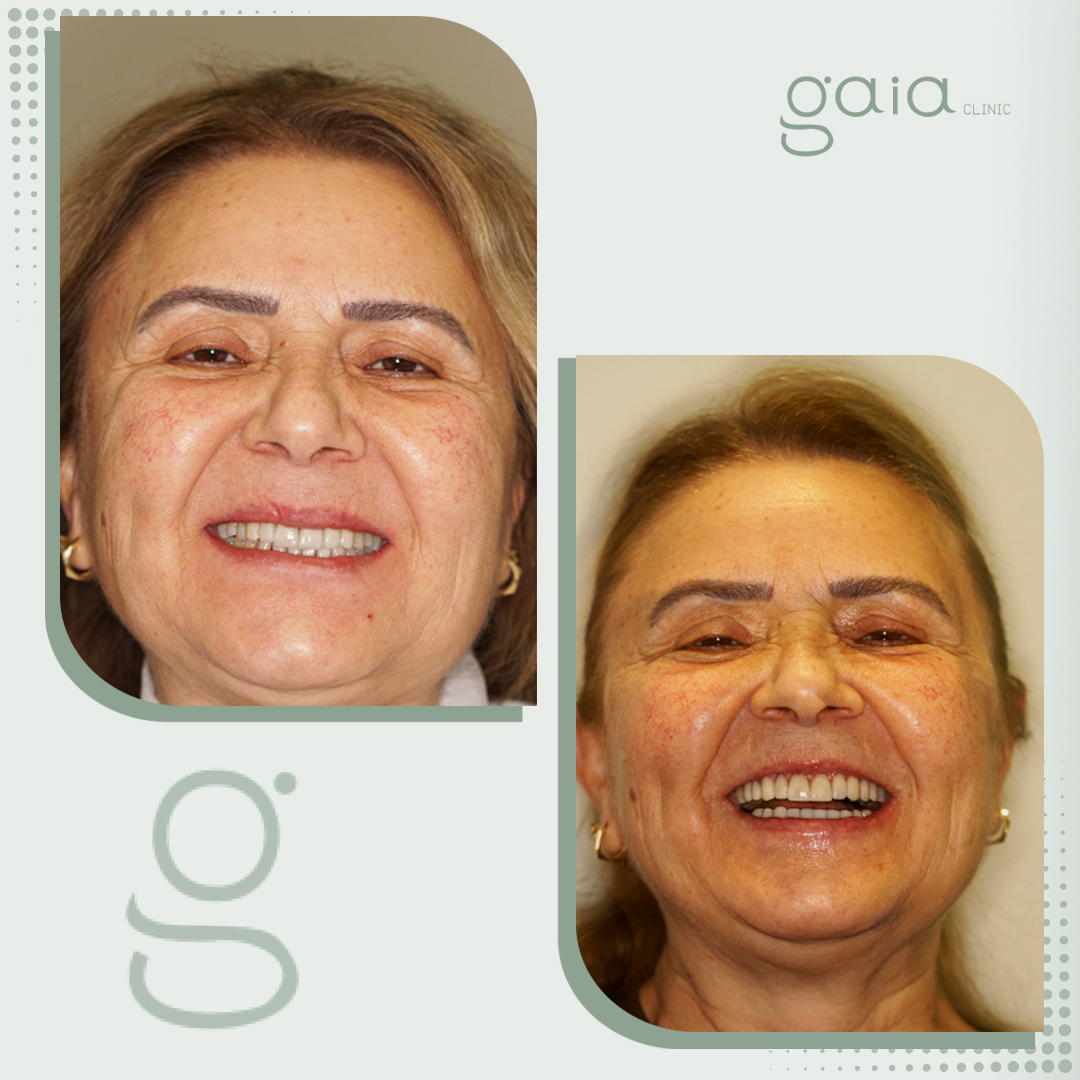 before-after