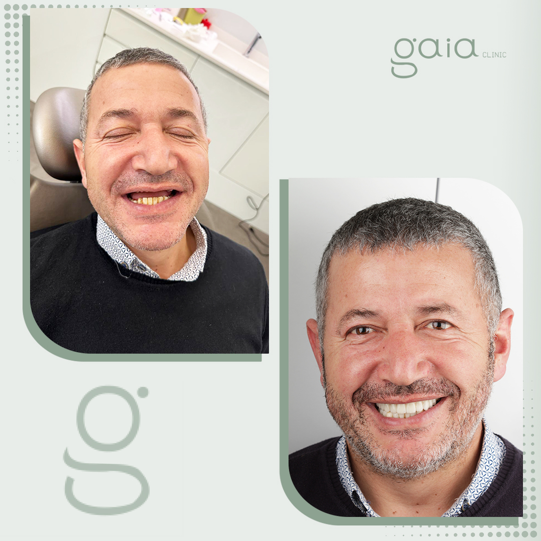 before-after