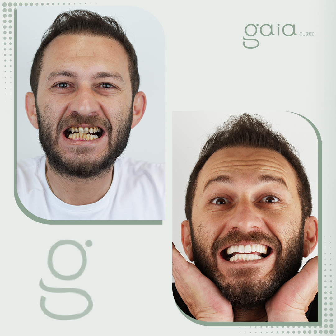 before-after