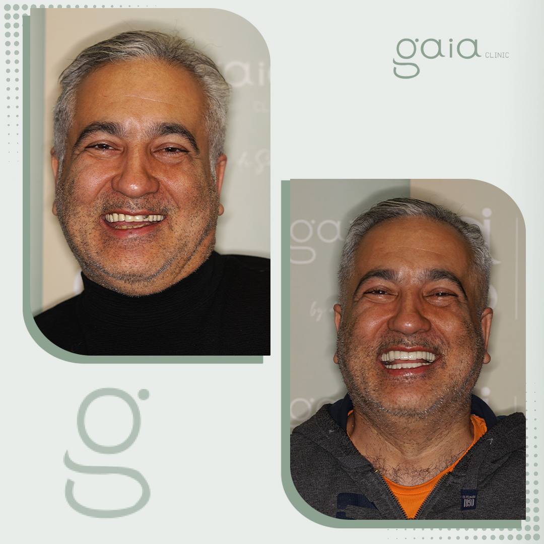 before-after