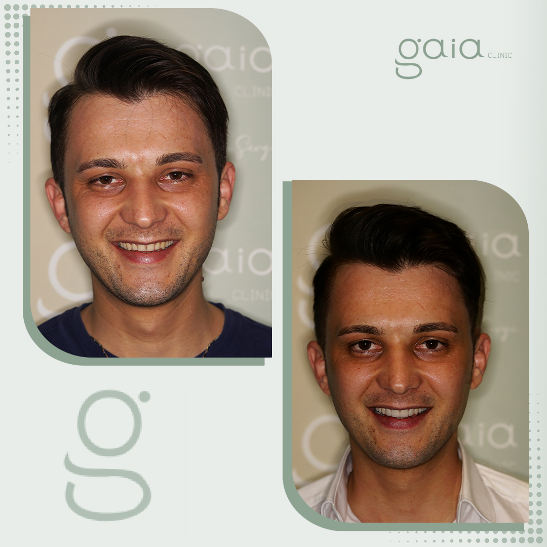 before-after