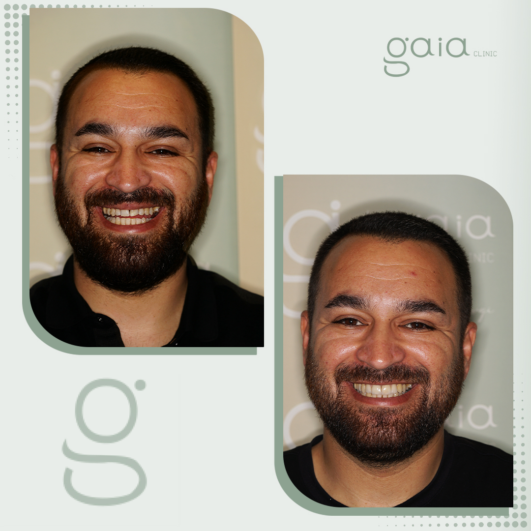 before-after
