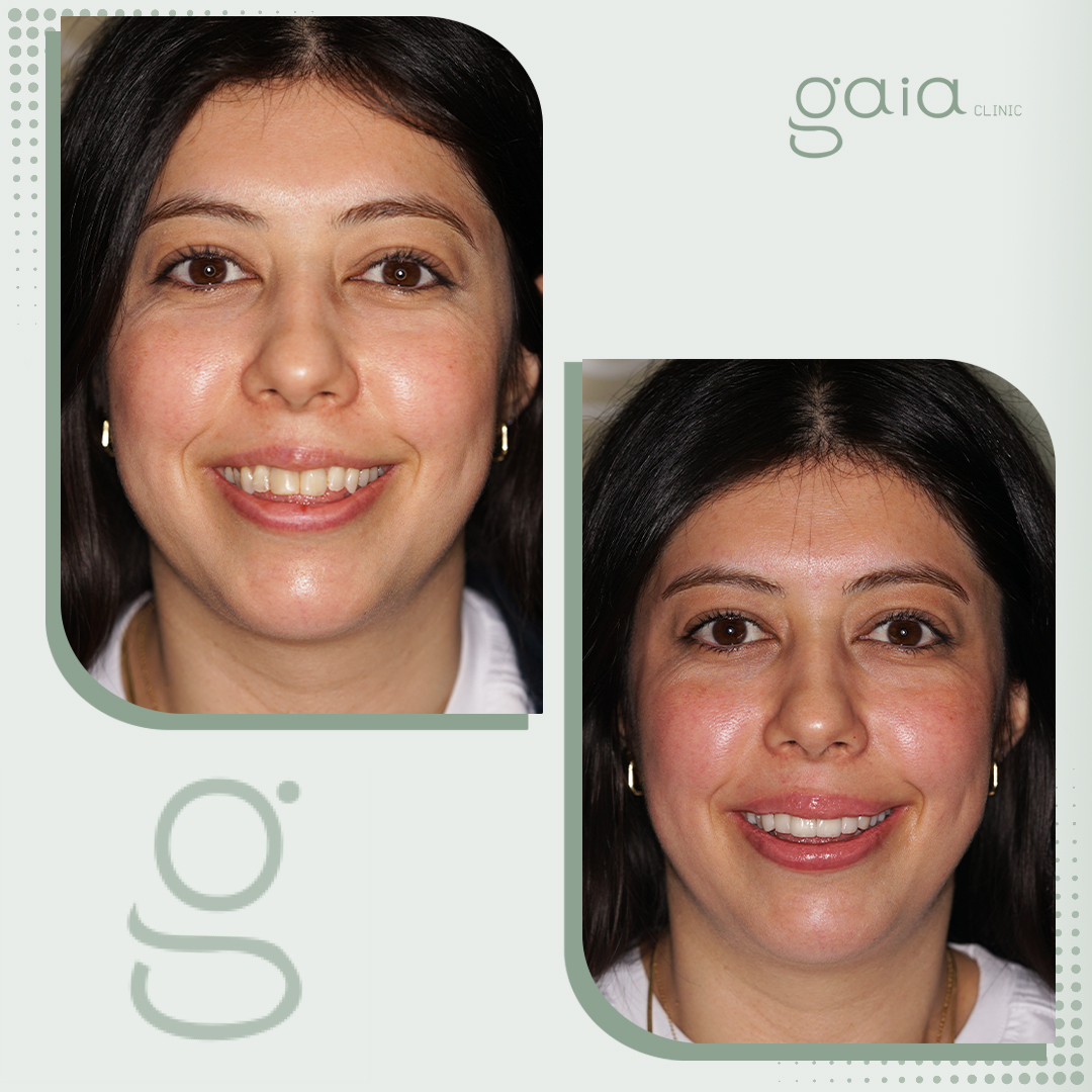 before-after