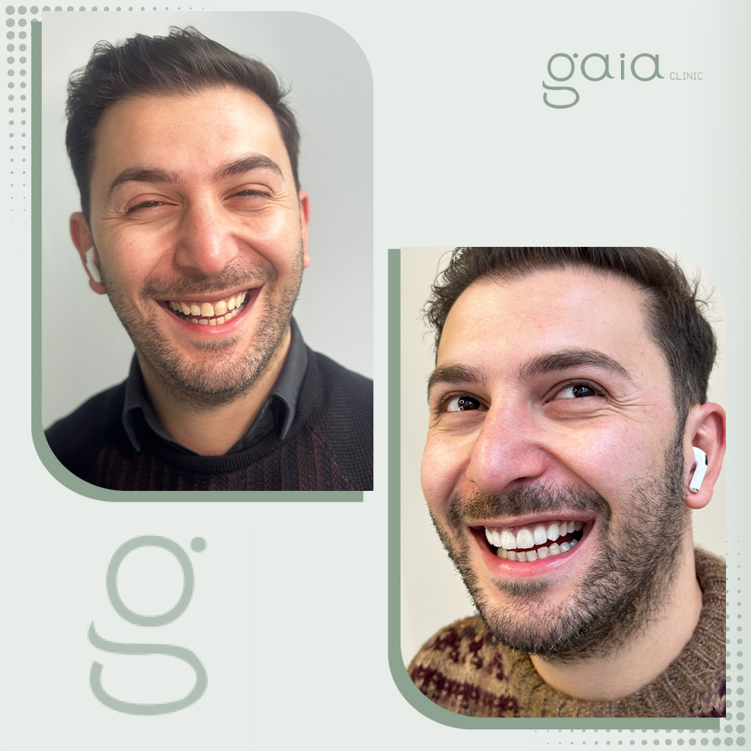 before-after