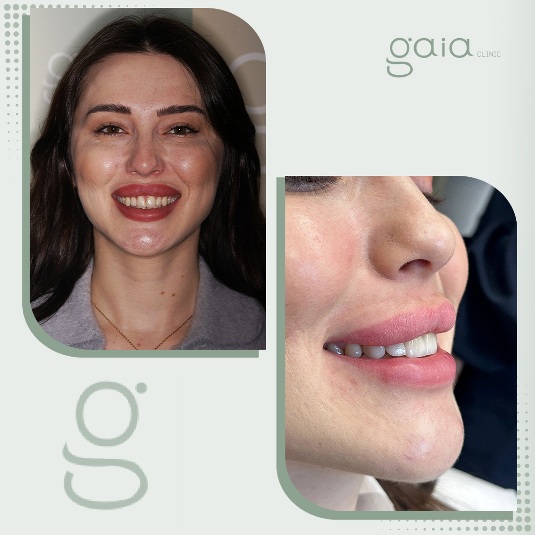 before-after