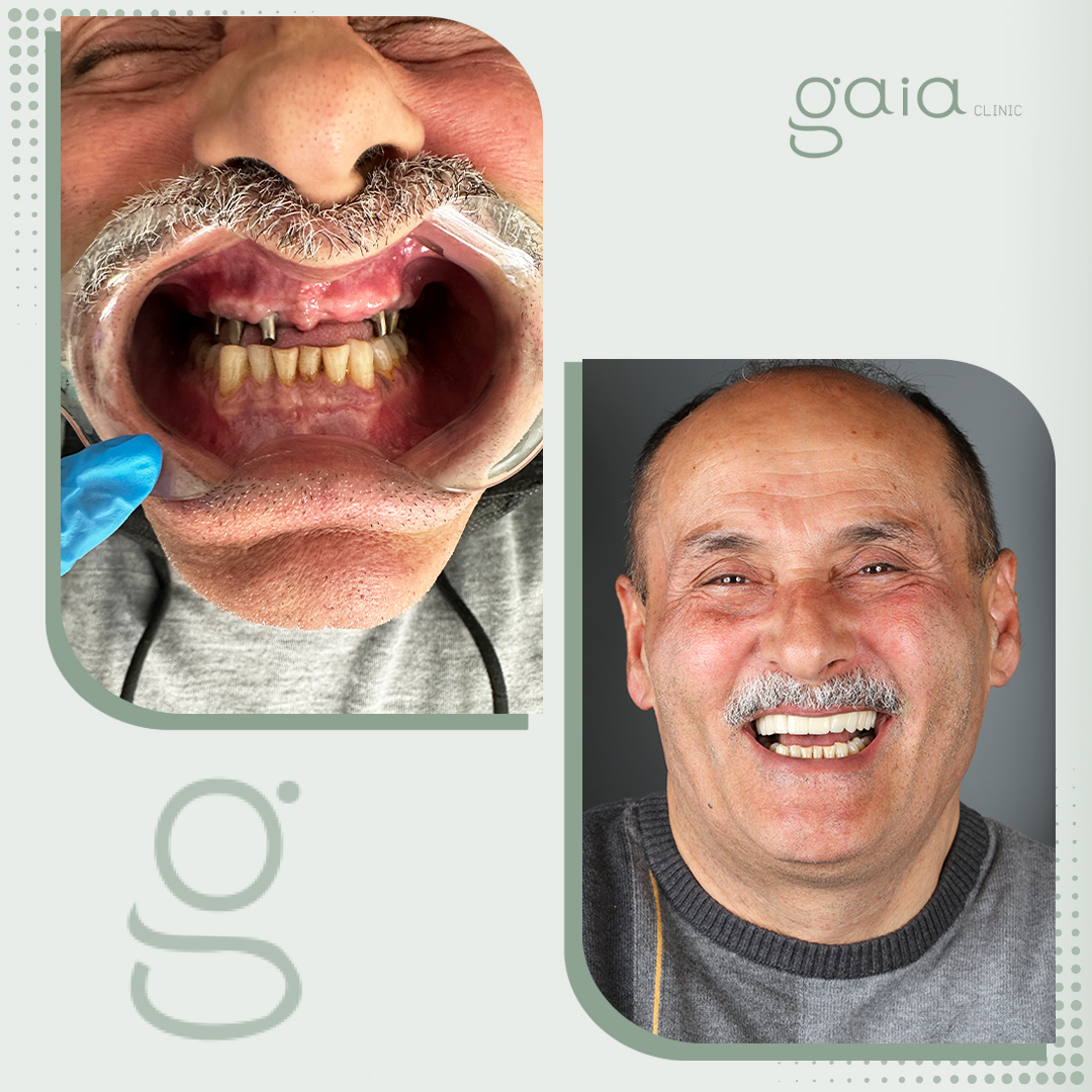 before-after
