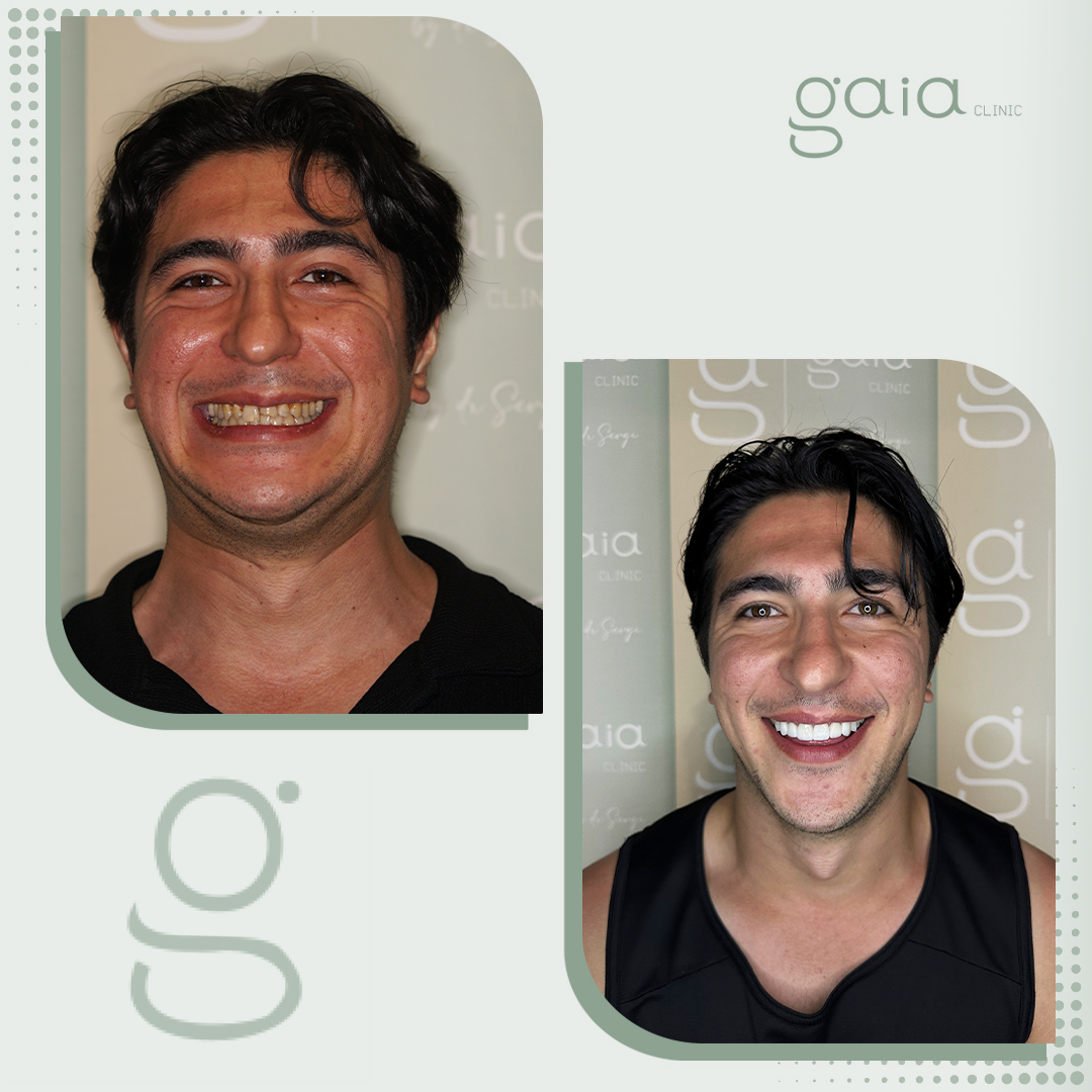 before-after