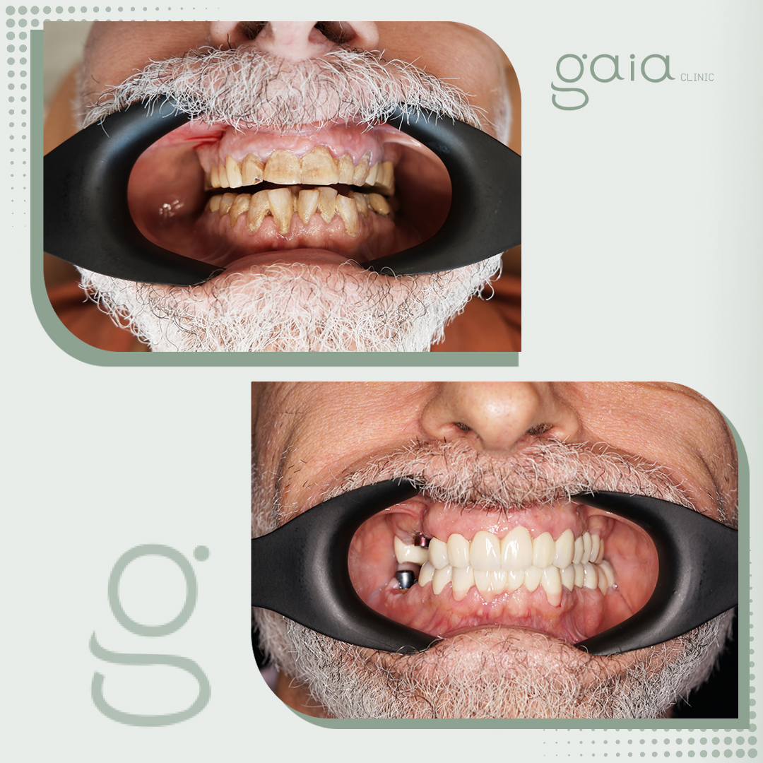 before-after