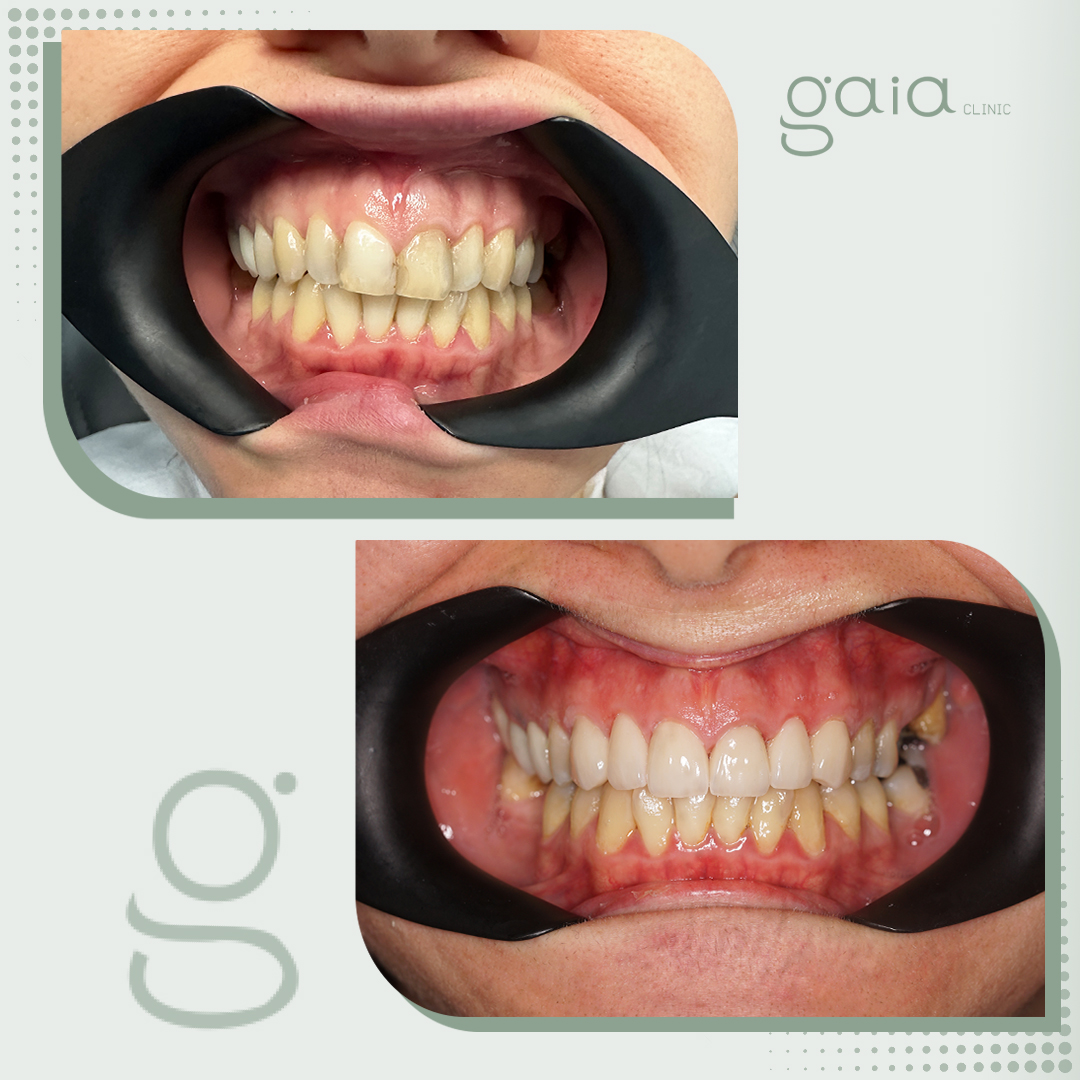 before-after