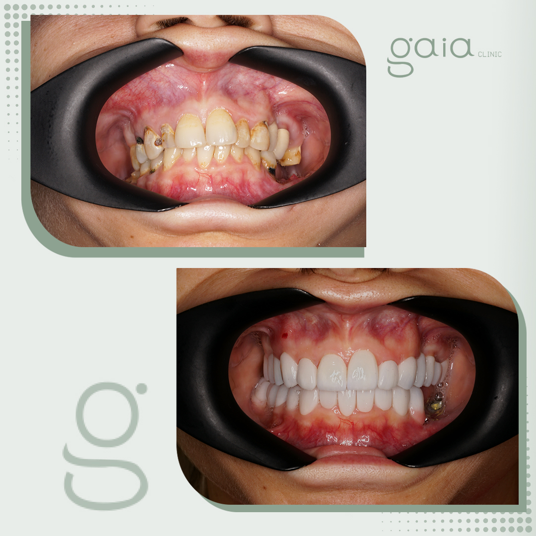 before-after