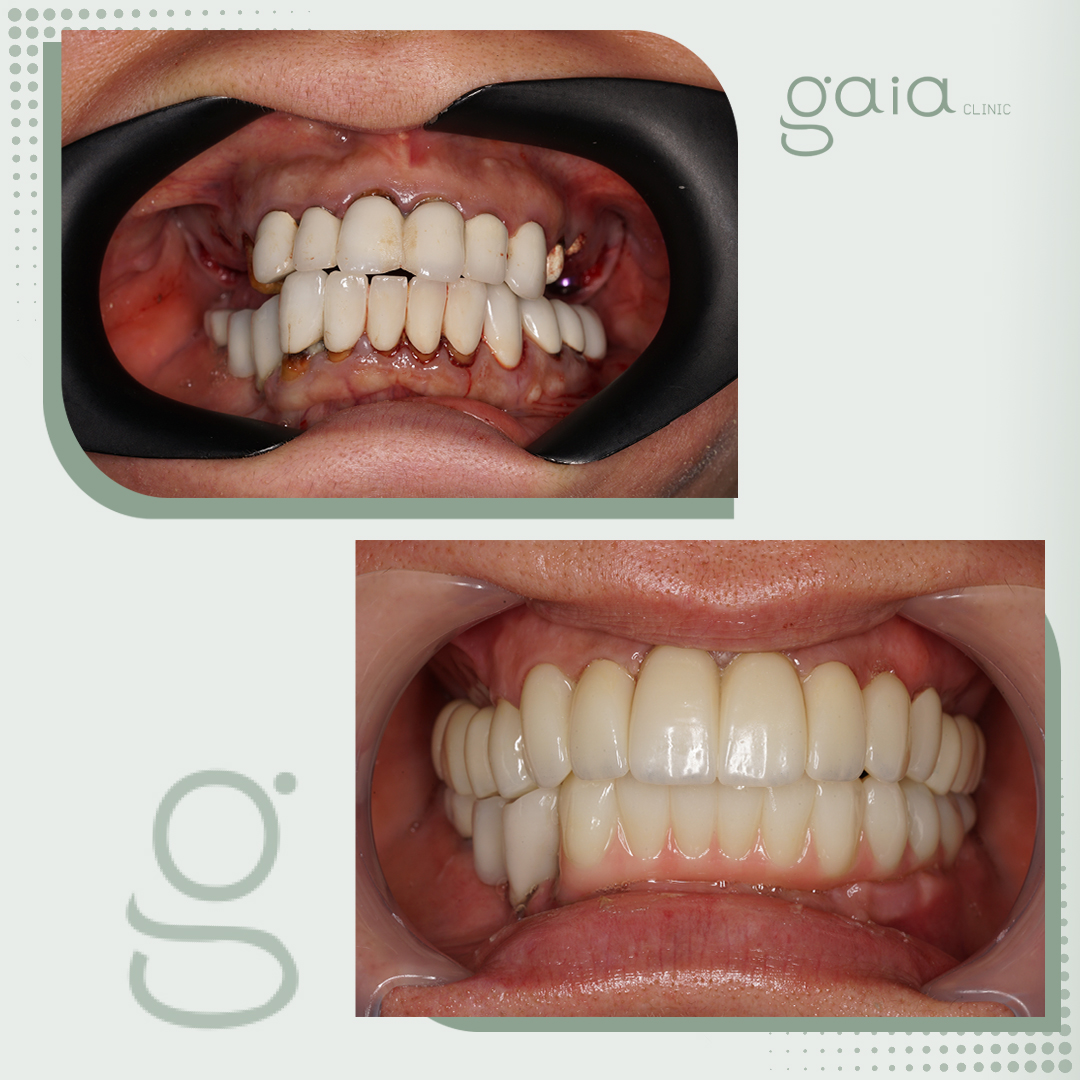 before-after