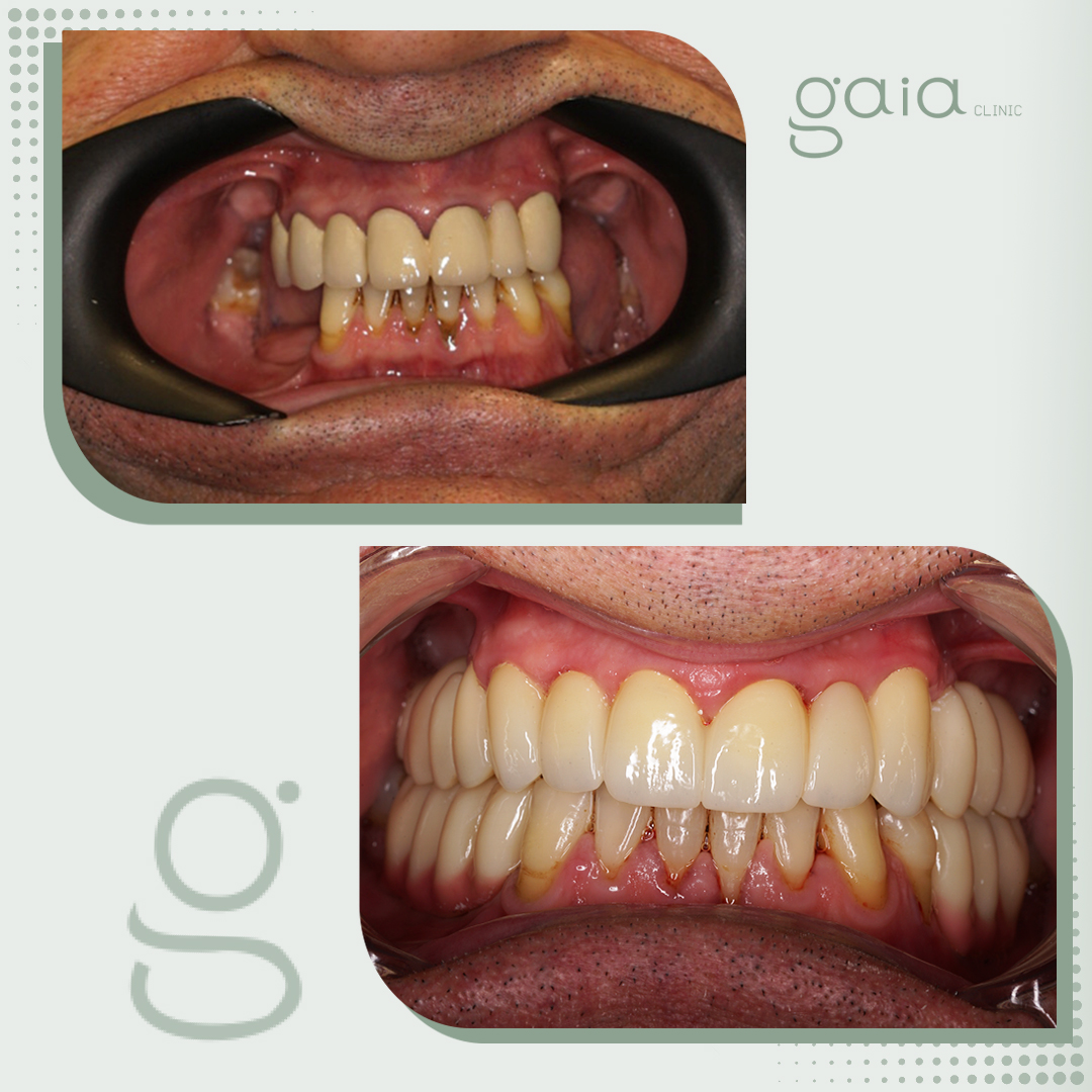 before-after