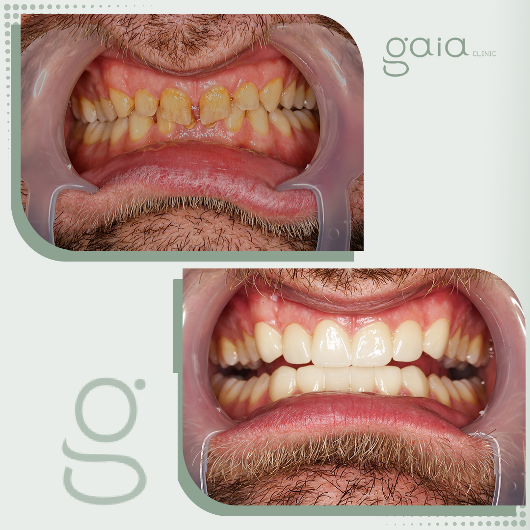 before-after
