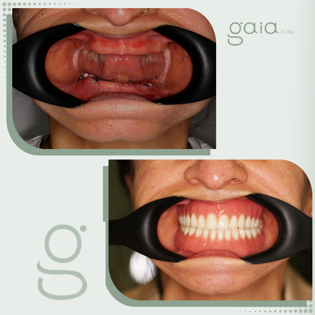 before-after