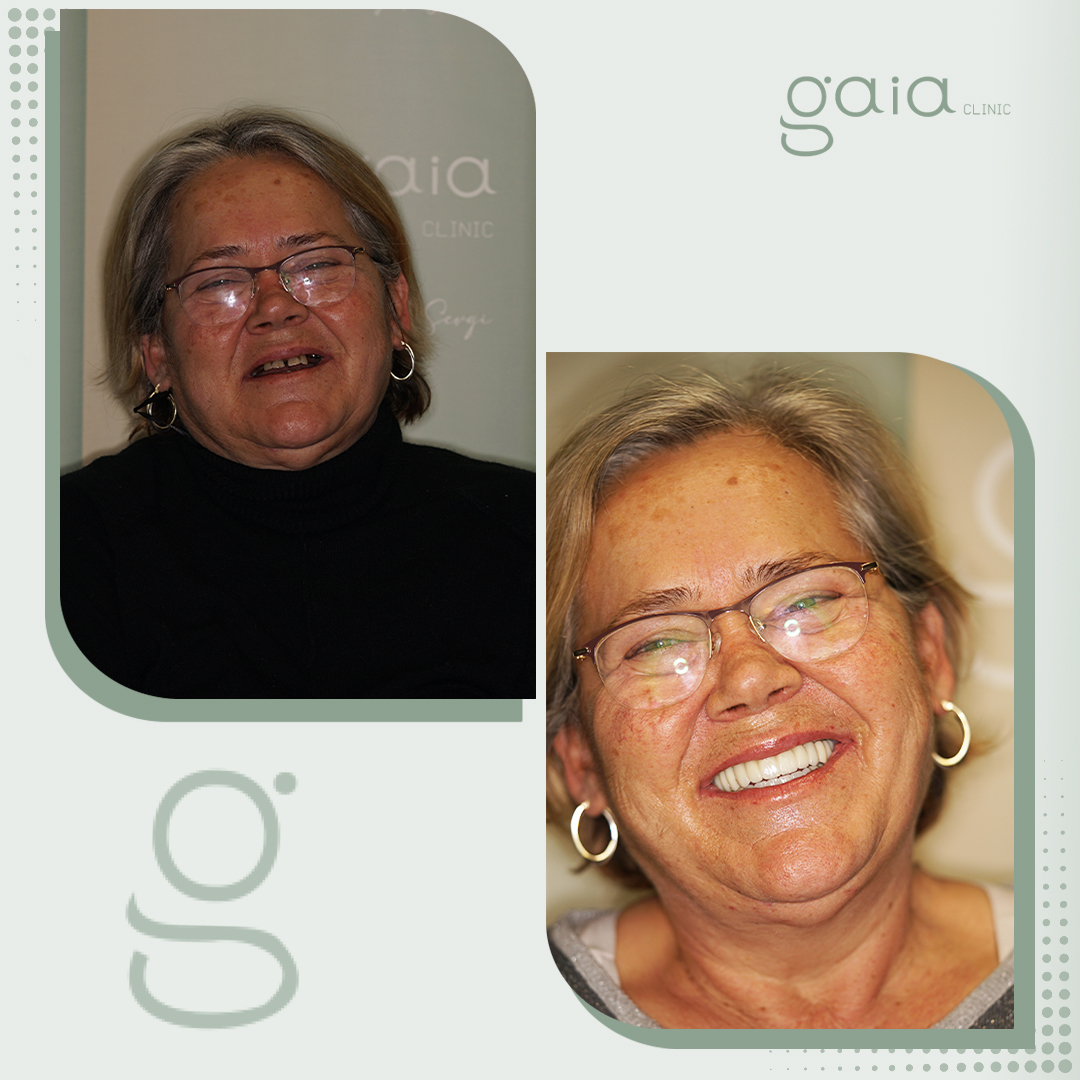 before-after
