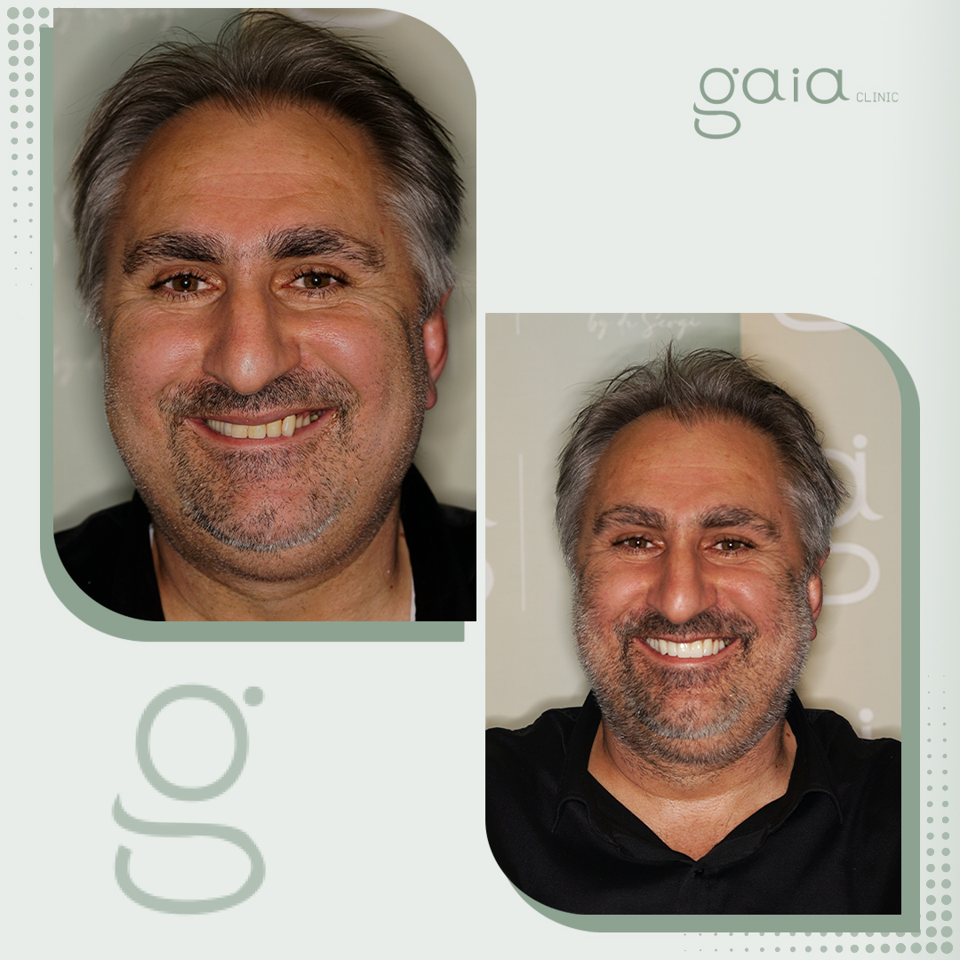 before-after