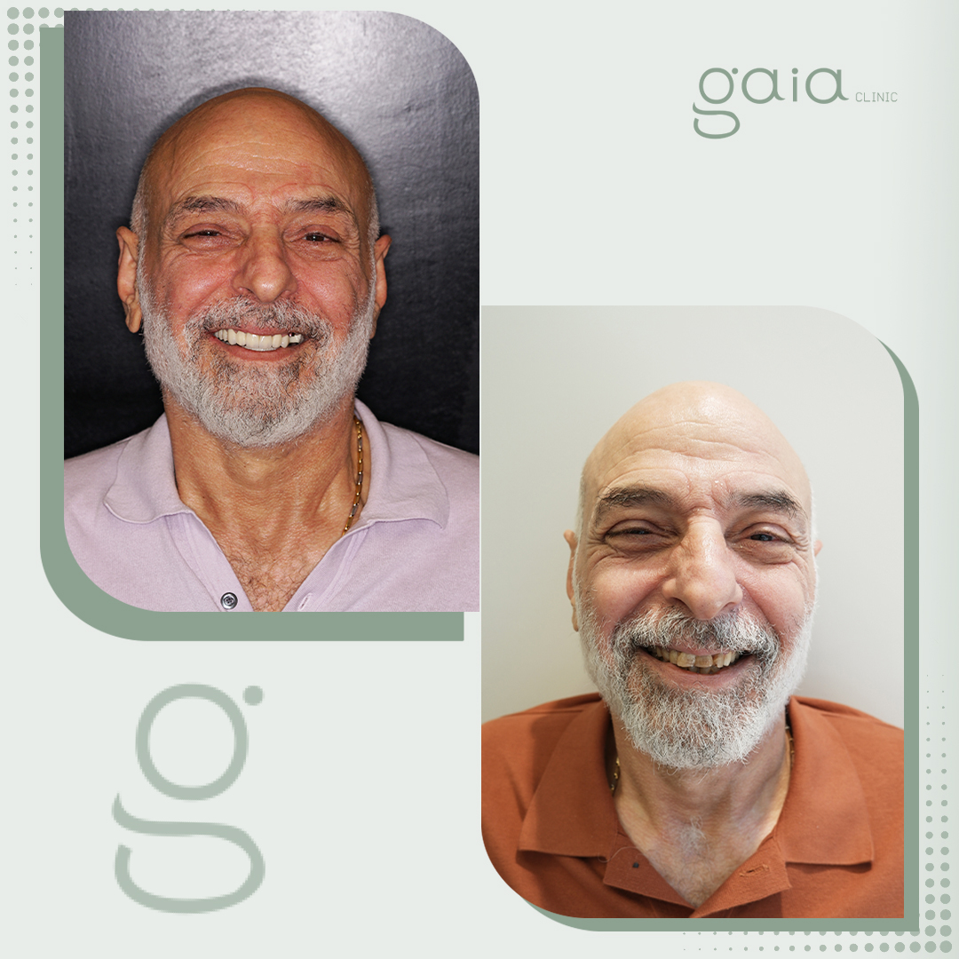 before-after