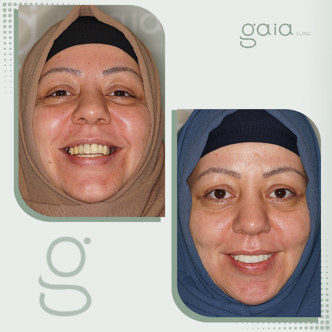 before-after