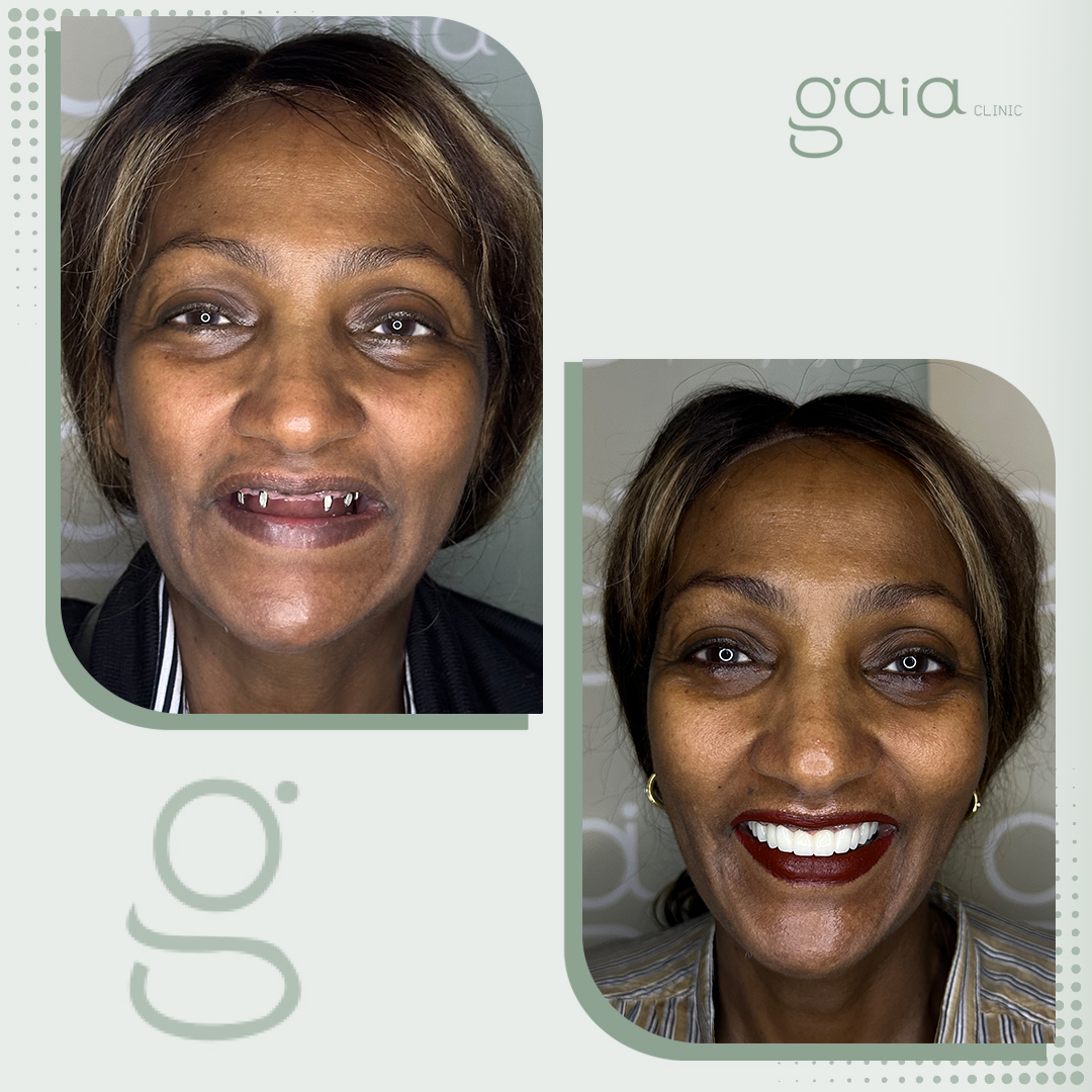 before-after