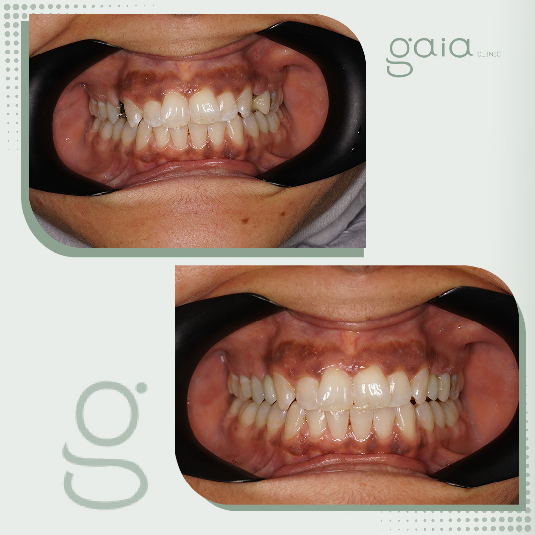 before-after