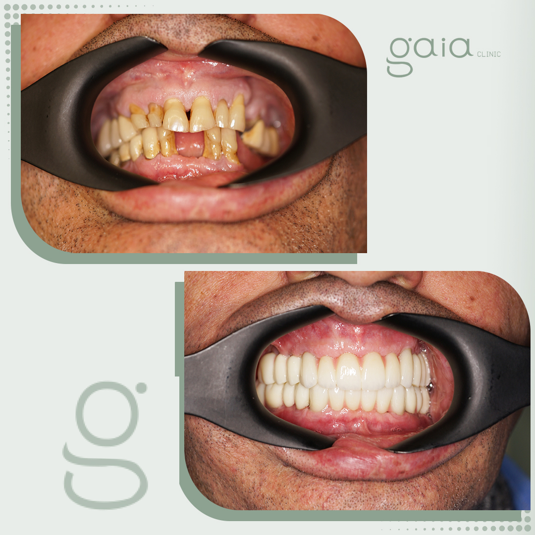 before-after